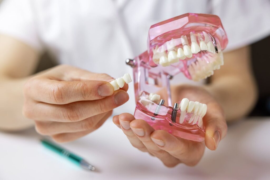 Dental Implants in Rancho Bernardo