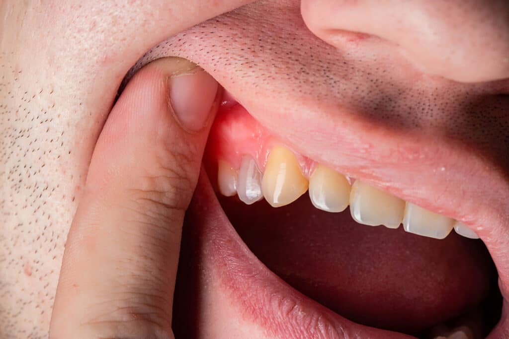 Gum Disease Treatment at Plaza Dentistry?