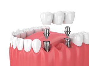 Dental Bridge Procedure