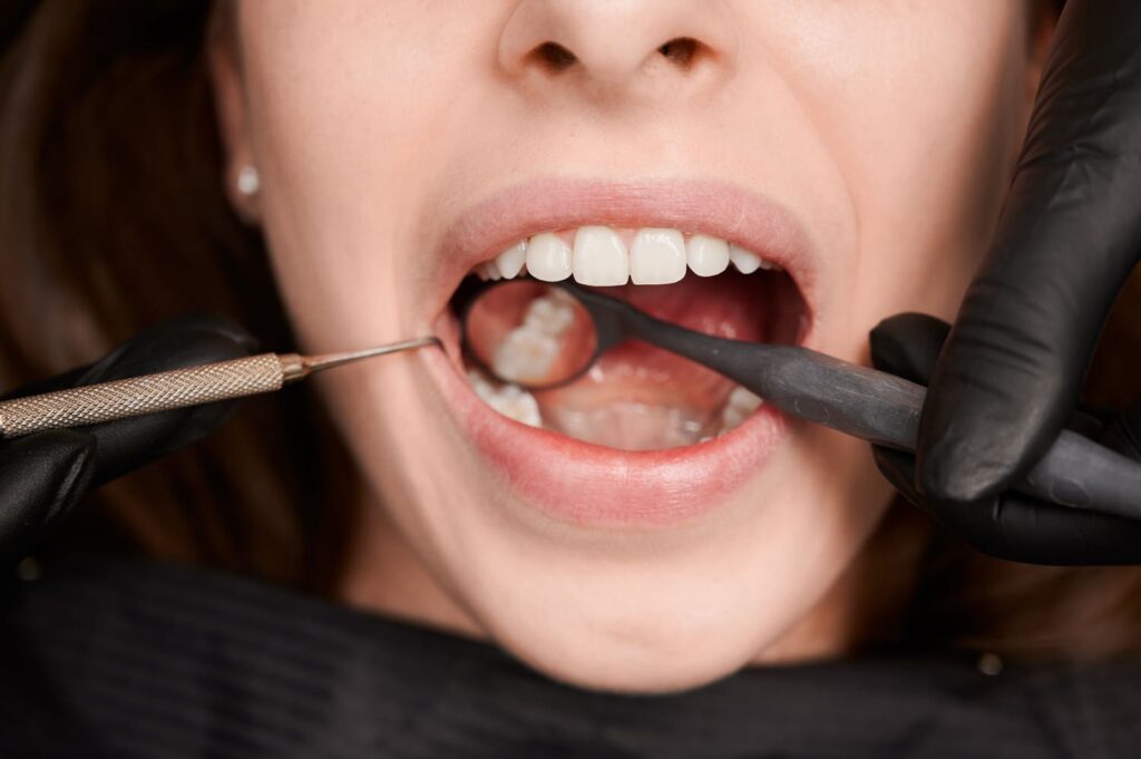 Dental Fillings in Rancho Bernardo