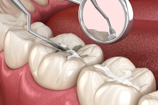 Dental Filling Procedure