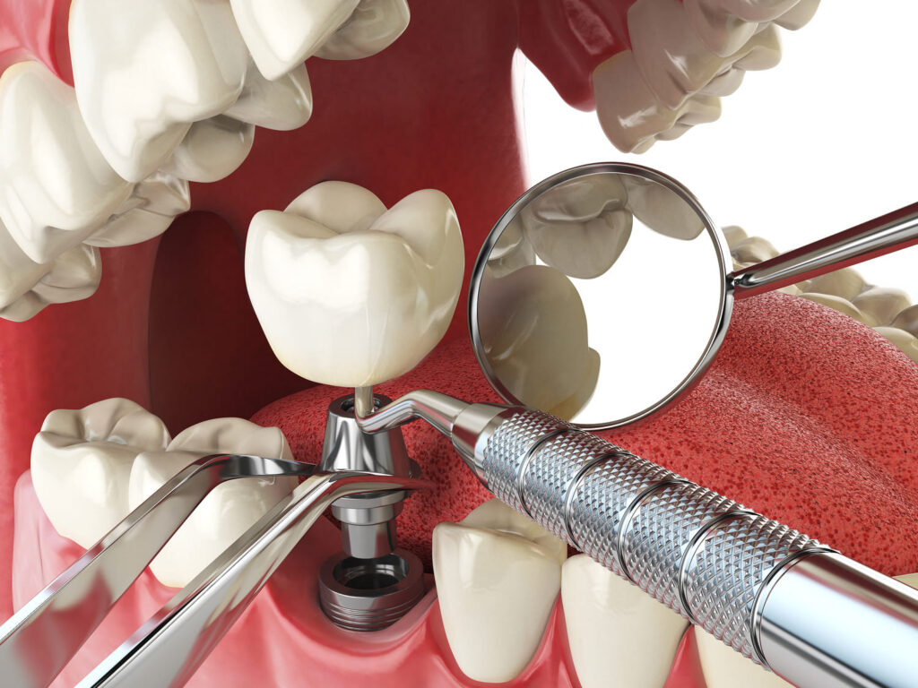 Dental implant demonstration with artificial crowns